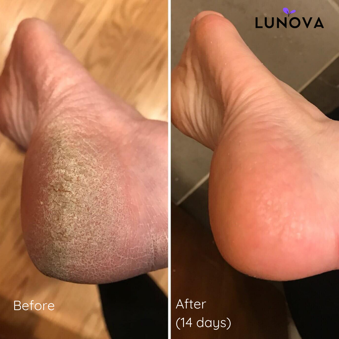 Callus Remover