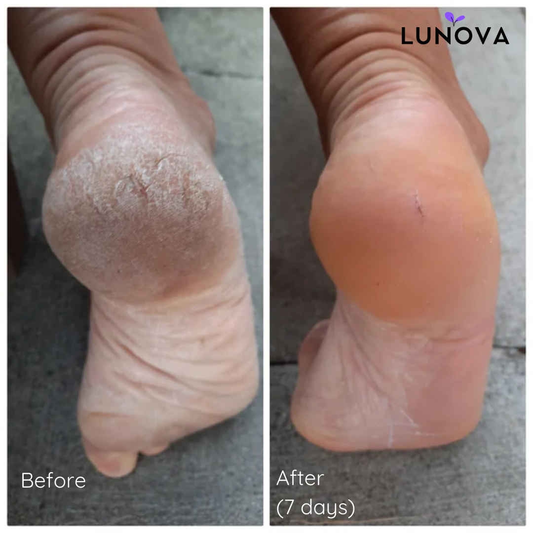 Callus Remover