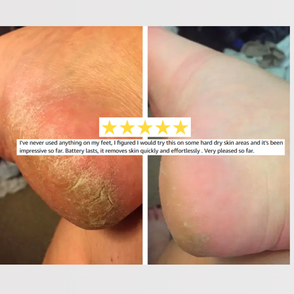 Callus Remover